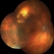 Sclerochoroidal Calcification Sclerochoroidal Calcification